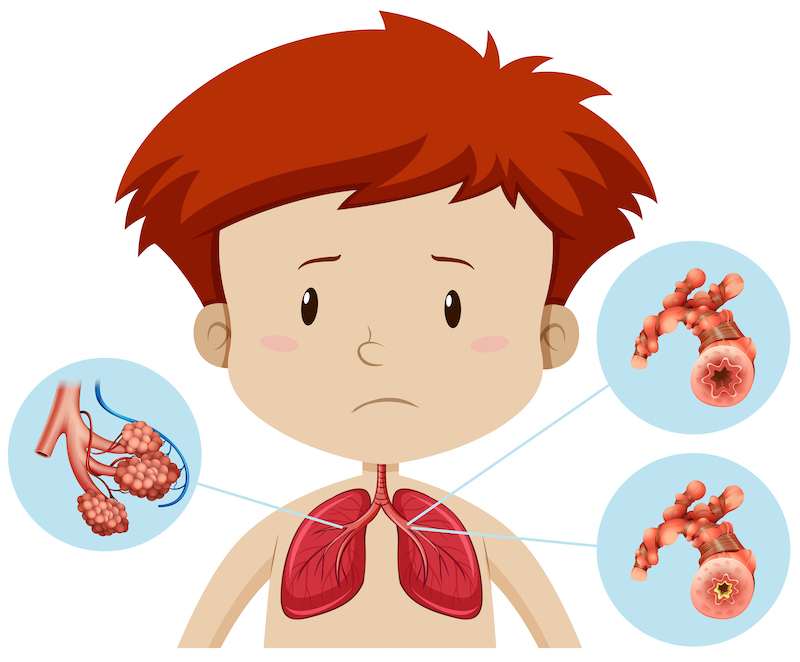 Bronchiolitis in children