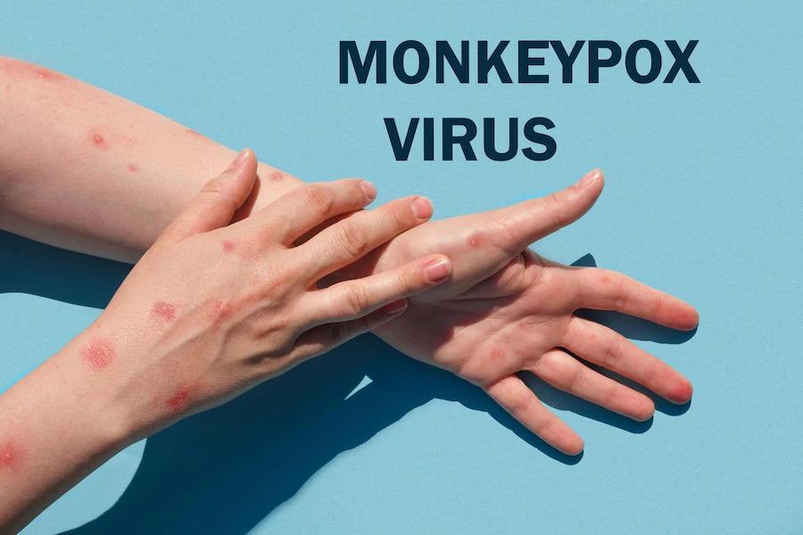 Monkeypox in India